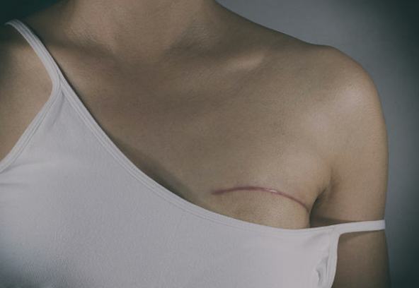 乳がん予後改善 運動療法